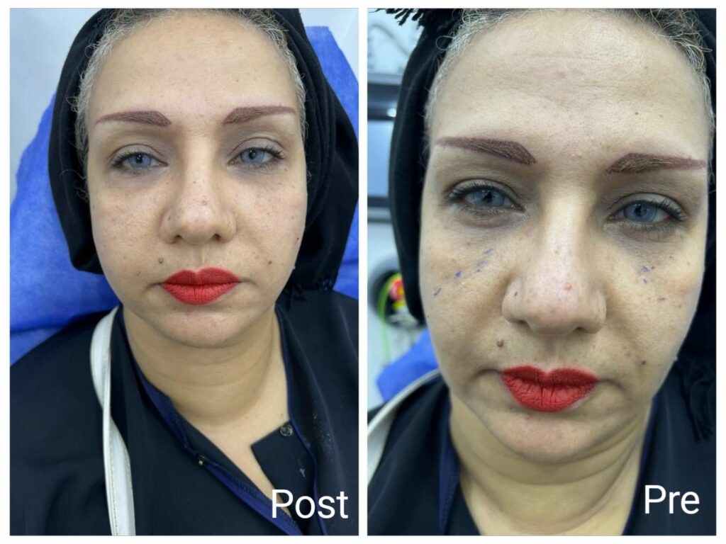 حقن الهيالورونيك للخدود وخط الابتسامة